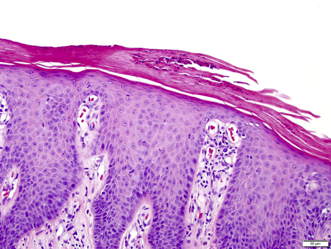 Skin Biopsy