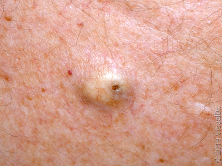 Cyst Removal
