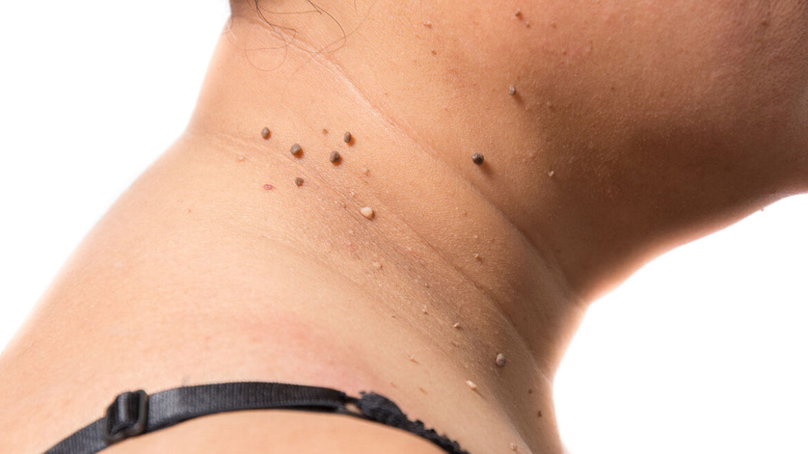 Skin Tags