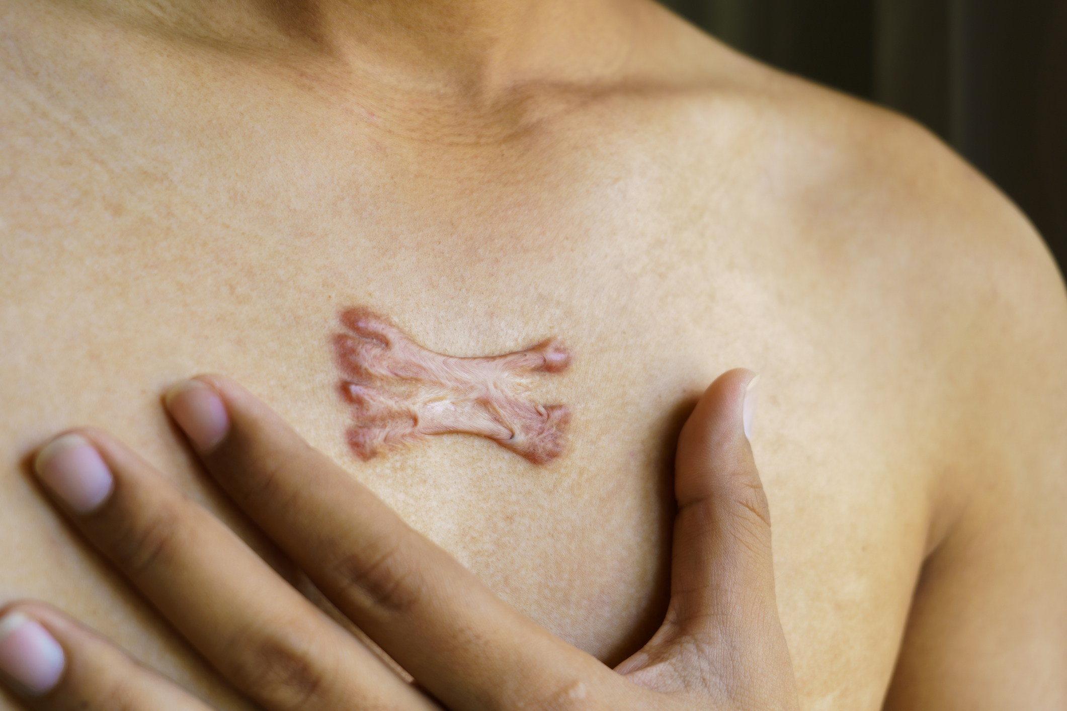 Keloids & Hypertrophic Scars