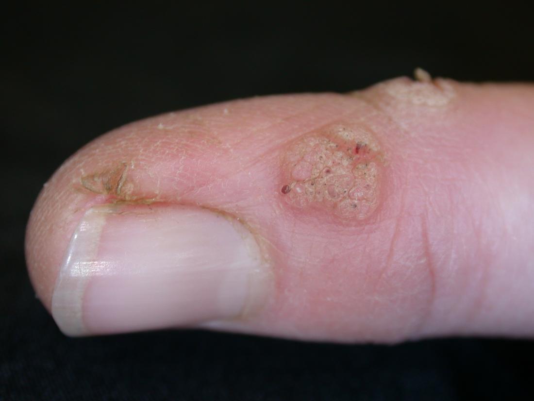 Warts