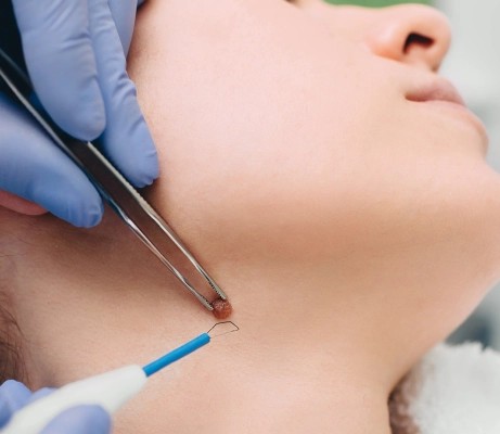 Radio-Frequency Ablation