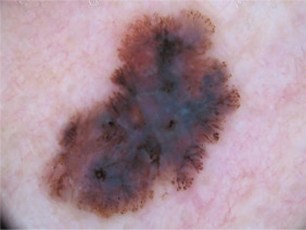 Skin Cancers
