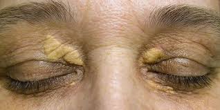Xanthelasma
