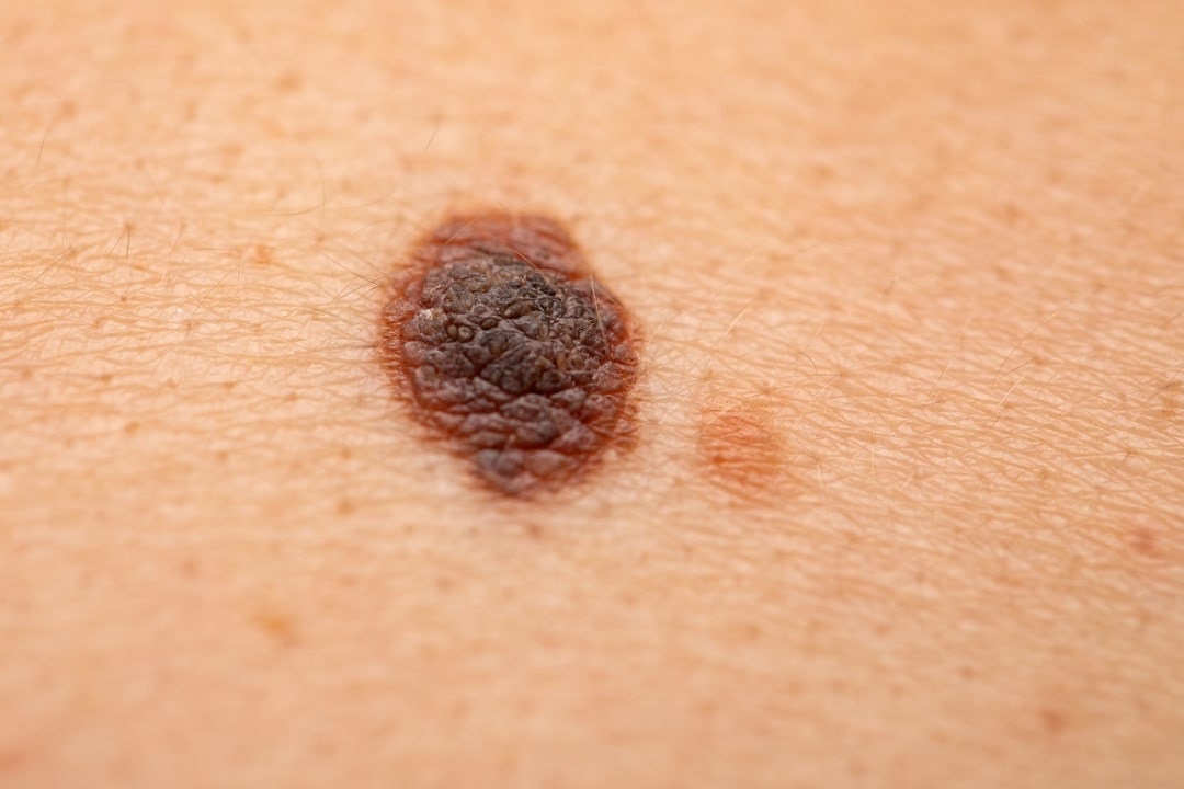 Seborrheic Keratosis