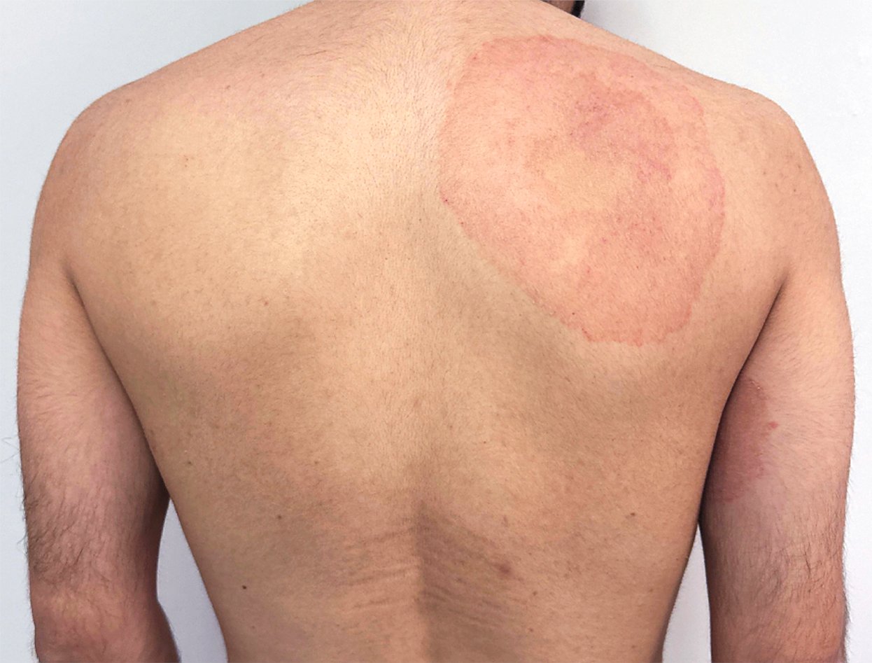Tinea