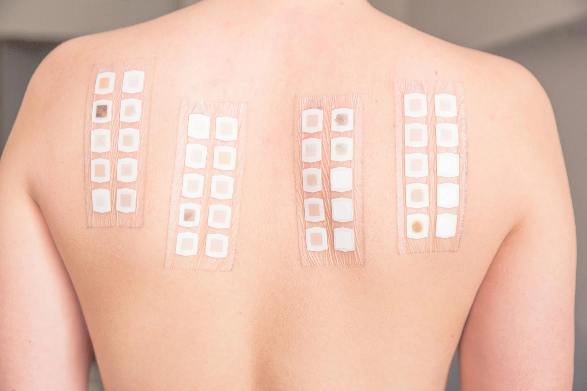 Patch testing 