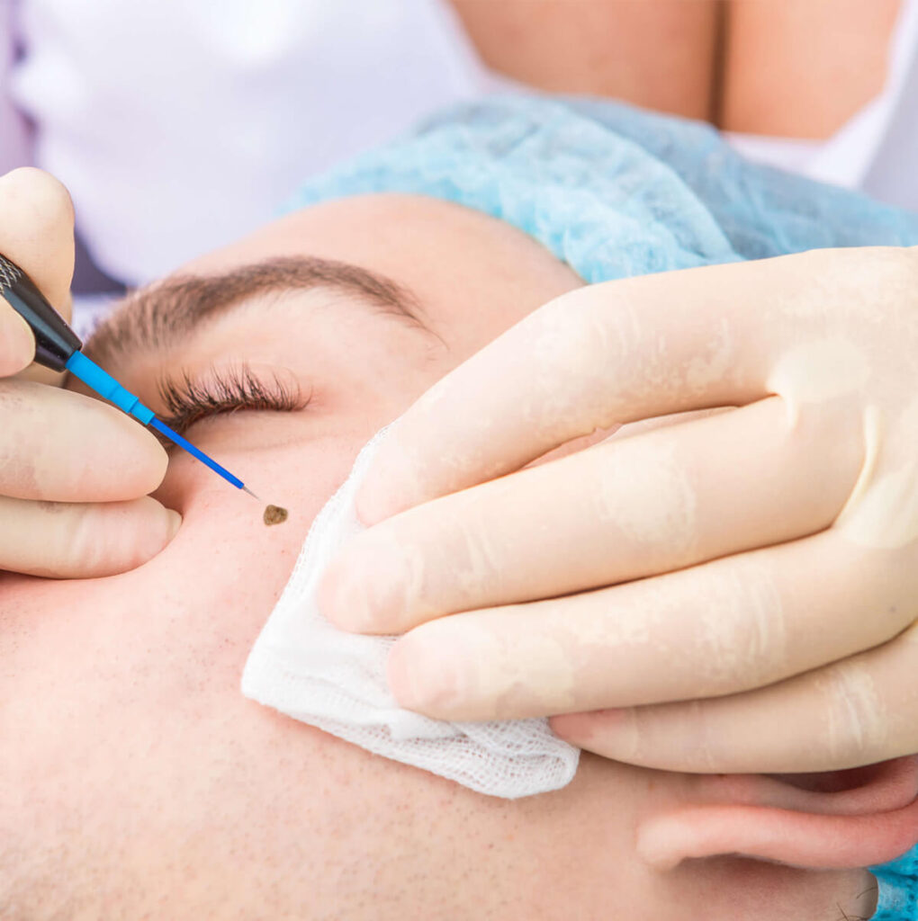Electrosurgery 
